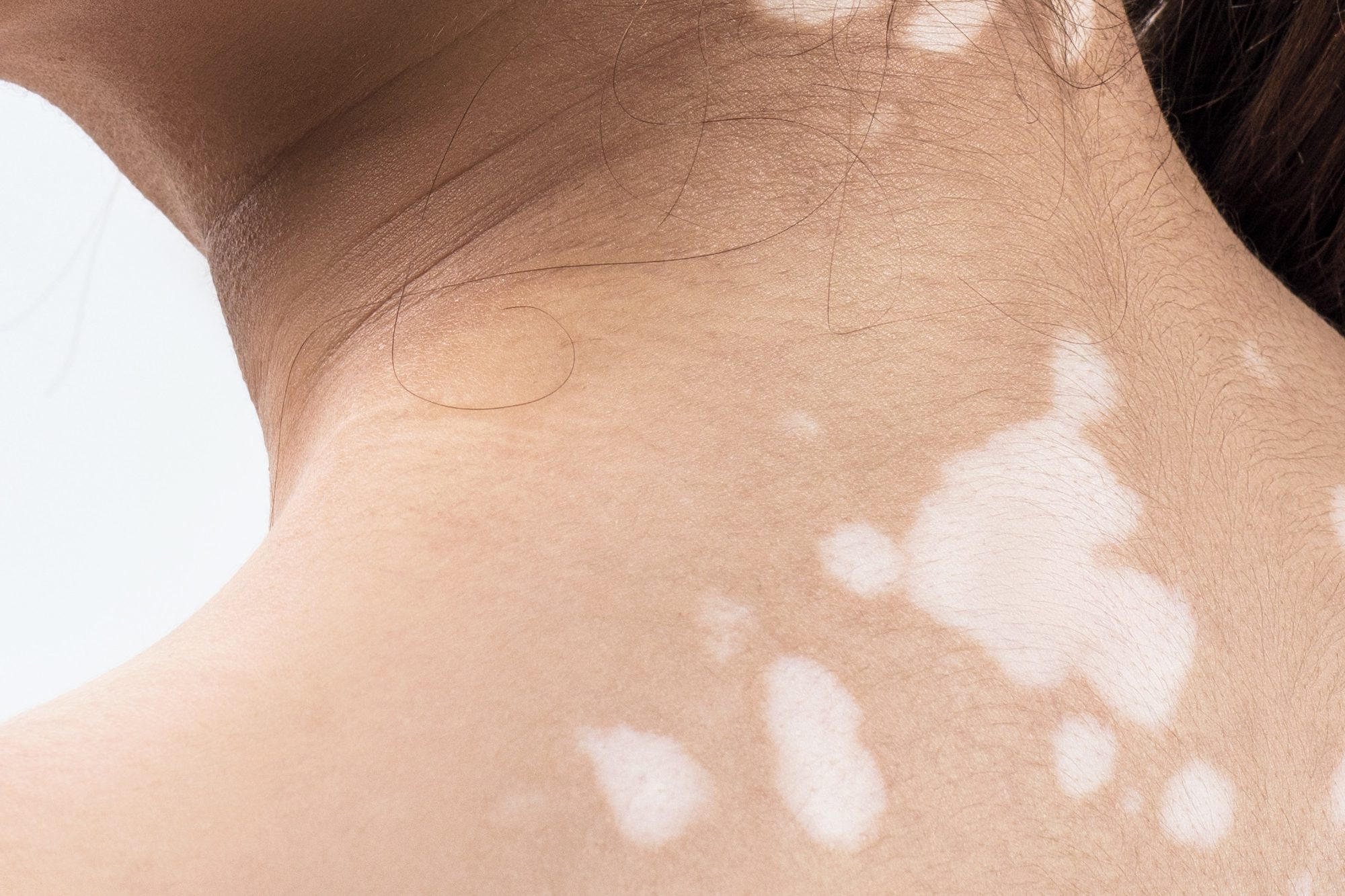 Banner vitiligo_crop de 2000x1333